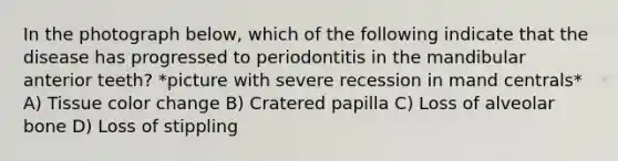 In the photograph below, which of the following indicate that the disease has progressed to periodontitis in the mandibular anterior teeth? *picture with severe recession in mand centrals* A) Tissue color change B) Cratered papilla C) Loss of alveolar bone D) Loss of stippling