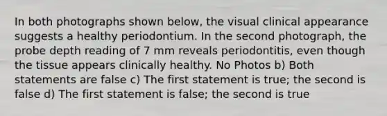 In both photographs shown below, the visual clinical appearance suggests a healthy periodontium. In the second photograph, the probe depth reading of 7 mm reveals periodontitis, even though the tissue appears clinically healthy. No Photos b) Both statements are false c) The first statement is true; the second is false d) The first statement is false; the second is true