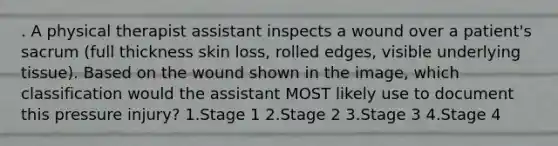 . A physical therapist assistant inspects a wound over a patient's sacrum (full thickness skin loss, rolled edges, visible underlying tissue). Based on the wound shown in the image, which classification would the assistant MOST likely use to document this pressure injury? 1.Stage 1 2.Stage 2 3.Stage 3 4.Stage 4