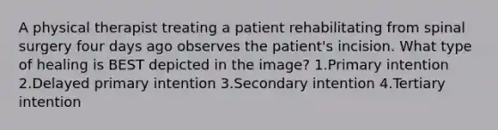 A physical therapist treating a patient rehabilitating from spinal surgery four days ago observes the patient's incision. What type of healing is BEST depicted in the image? 1.Primary intention 2.Delayed primary intention 3.Secondary intention 4.Tertiary intention