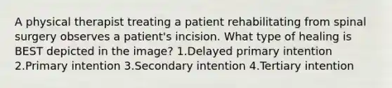 A physical therapist treating a patient rehabilitating from spinal surgery observes a patient's incision. What type of healing is BEST depicted in the image? 1.Delayed primary intention 2.Primary intention 3.Secondary intention 4.Tertiary intention