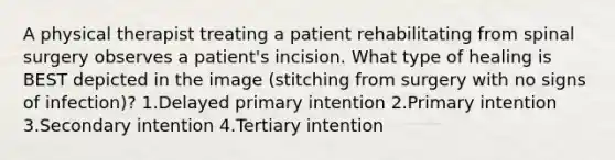 A physical therapist treating a patient rehabilitating from spinal surgery observes a patient's incision. What type of healing is BEST depicted in the image (stitching from surgery with no signs of infection)? 1.Delayed primary intention 2.Primary intention 3.Secondary intention 4.Tertiary intention