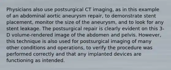 Physicians also use postsurgical CT imaging, as in this example of an abdominal aortic aneurysm repair, to demonstrate stent placement, monitor the size of the aneurysm, and to look for any stent leakage. The postsurgical repair is clearly evident on this 3-D volume-rendered image of the abdomen and pelvis. However, this technique is also used for postsurgical imaging of many other conditions and operations, to verify the procedure was performed correctly and that any implanted devices are functioning as intended.