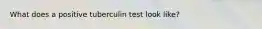 What does a positive tuberculin test look like?