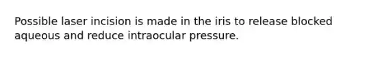 Possible laser incision is made in the iris to release blocked aqueous and reduce intraocular pressure.