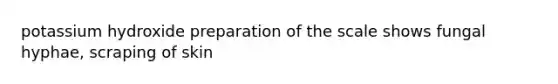 potassium hydroxide preparation of the scale shows fungal hyphae, scraping of skin