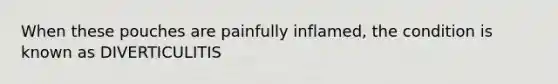 When these pouches are painfully inflamed, the condition is known as DIVERTICULITIS