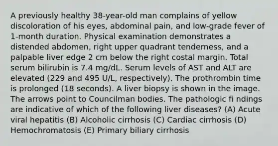 A previously healthy 38-year-old man complains of yellow discoloration of his eyes, abdominal pain, and low-grade fever of 1-month duration. Physical examination demonstrates a distended abdomen, right upper quadrant tenderness, and a palpable liver edge 2 cm below the right costal margin. Total serum bilirubin is 7.4 mg/dL. Serum levels of AST and ALT are elevated (229 and 495 U/L, respectively). The prothrombin time is prolonged (18 seconds). A liver biopsy is shown in the image. The arrows point to Councilman bodies. The pathologic fi ndings are indicative of which of the following liver diseases? (A) Acute viral hepatitis (B) Alcoholic cirrhosis (C) Cardiac cirrhosis (D) Hemochromatosis (E) Primary biliary cirrhosis