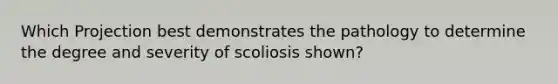 Which Projection best demonstrates the pathology to determine the degree and severity of scoliosis shown?