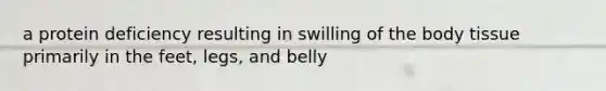 a protein deficiency resulting in swilling of the body tissue primarily in the feet, legs, and belly