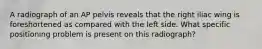 A radiograph of an AP pelvis reveals that the right iliac wing is foreshortened as compared with the left side. What specific positioning problem is present on this radiograph?