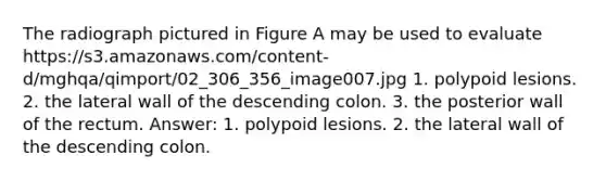 The radiograph pictured in Figure A may be used to evaluate https://s3.amazonaws.com/content-d/mghqa/qimport/02_306_356_image007.jpg 1. polypoid lesions. 2. the lateral wall of the descending colon. 3. the posterior wall of the rectum. Answer: 1. polypoid lesions. 2. the lateral wall of the descending colon.