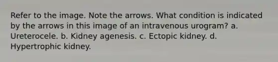 Refer to the image. Note the arrows. What condition is indicated by the arrows in this image of an intravenous urogram? a. Ureterocele. b. Kidney agenesis. c. Ectopic kidney. d. Hypertrophic kidney.