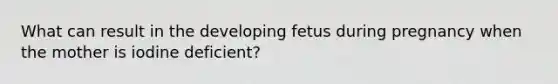 What can result in the developing fetus during pregnancy when the mother is iodine deficient?