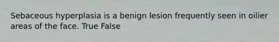 Sebaceous hyperplasia is a benign lesion frequently seen in oilier areas of the face. True False