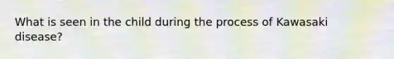 What is seen in the child during the process of Kawasaki disease?