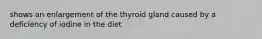 shows an enlargement of the thyroid gland caused by a deficiency of iodine in the diet