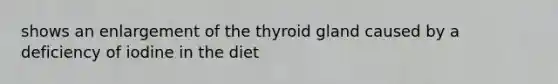 shows an enlargement of the thyroid gland caused by a deficiency of iodine in the diet