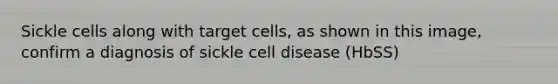 Sickle cells along with target cells, as shown in this image, confirm a diagnosis of sickle cell disease (HbSS)