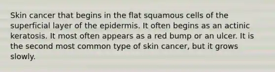 Skin cancer that begins in the flat squamous cells of the superficial layer of the epidermis. It often begins as an actinic keratosis. It most often appears as a red bump or an ulcer. It is the second most common type of skin cancer, but it grows slowly.