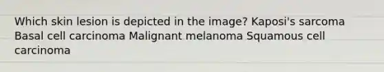 Which skin lesion is depicted in the image? Kaposi's sarcoma Basal cell carcinoma Malignant melanoma Squamous cell carcinoma