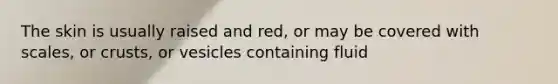 The skin is usually raised and red, or may be covered with scales, or crusts, or vesicles containing fluid