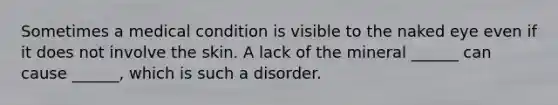 Sometimes a medical condition is visible to the naked eye even if it does not involve the skin. A lack of the mineral ______ can cause ______, which is such a disorder.