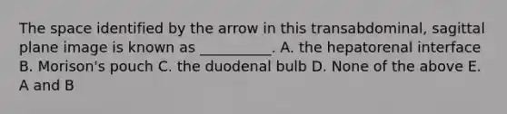 The space identified by the arrow in this transabdominal, sagittal plane image is known as __________. A. the hepatorenal interface B. Morison's pouch C. the duodenal bulb D. None of the above E. A and B