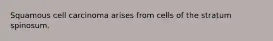 Squamous cell carcinoma arises from cells of the stratum spinosum.