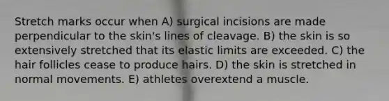 Stretch marks occur when A) surgical incisions are made perpendicular to the skin's lines of cleavage. B) the skin is so extensively stretched that its elastic limits are exceeded. C) the hair follicles cease to produce hairs. D) the skin is stretched in normal movements. E) athletes overextend a muscle.