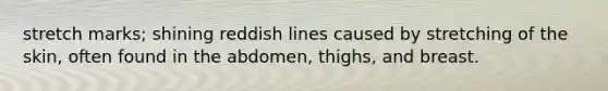 stretch marks; shining reddish lines caused by stretching of the skin, often found in the abdomen, thighs, and breast.