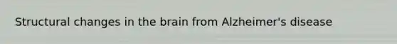 Structural changes in the brain from Alzheimer's disease
