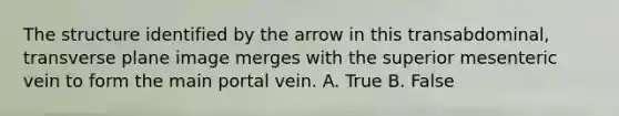 The structure identified by the arrow in this transabdominal, transverse plane image merges with the superior mesenteric vein to form the main portal vein. A. True B. False