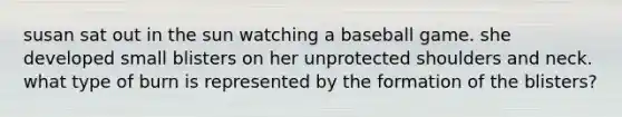 susan sat out in the sun watching a baseball game. she developed small blisters on her unprotected shoulders and neck. what type of burn is represented by the formation of the blisters?