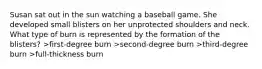 Susan sat out in the sun watching a baseball game. She developed small blisters on her unprotected shoulders and neck. What type of burn is represented by the formation of the blisters? >first-degree burn >second-degree burn >third-degree burn >full-thickness burn