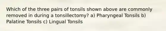 Which of the three pairs of tonsils shown above are commonly removed in during a tonsillectomy? a) Pharyngeal Tonsils b) Palatine Tonsils c) Lingual Tonsils