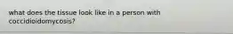 what does the tissue look like in a person with coccidioidomycosis?