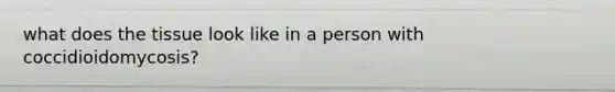 what does the tissue look like in a person with coccidioidomycosis?