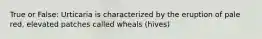 True or False: Urticaria is characterized by the eruption of pale red, elevated patches called wheals (hives)
