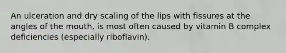 An ulceration and dry scaling of the lips with fissures at the angles of the mouth, is most often caused by vitamin B complex deficiencies (especially riboflavin).