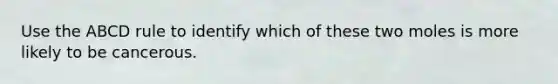Use the ABCD rule to identify which of these two moles is more likely to be cancerous.