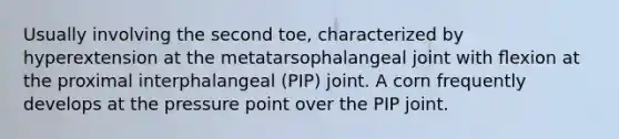 Usually involving the second toe, characterized by hyperextension at the metatarsophalangeal joint with ﬂexion at the proximal interphalangeal (PIP) joint. A corn frequently develops at the pressure point over the PIP joint.