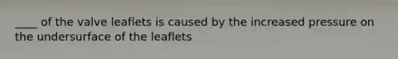 ____ of the valve leaflets is caused by the increased pressure on the undersurface of the leaflets