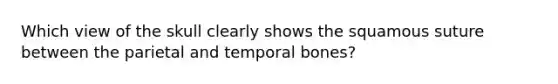Which view of the skull clearly shows the squamous suture between the parietal and temporal bones?
