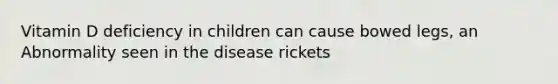 Vitamin D deficiency in children can cause bowed legs, an Abnormality seen in the disease rickets