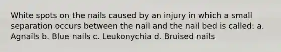 White spots on the nails caused by an injury in which a small separation occurs between the nail and the nail bed is called: a. Agnails b. Blue nails c. Leukonychia d. Bruised nails