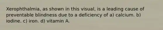 Xerophthalmia, as shown in this visual, is a leading cause of preventable blindness due to a deficiency of a) calcium. b) iodine. c) iron. d) vitamin A.