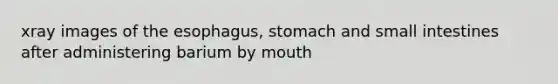 xray images of <a href='https://www.questionai.com/knowledge/kSjVhaa9qF-the-esophagus' class='anchor-knowledge'>the esophagus</a>, stomach and small intestines after administering barium by mouth