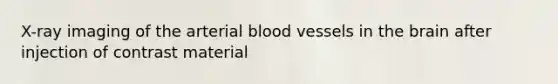 X-ray imaging of the arterial blood vessels in the brain after injection of contrast material