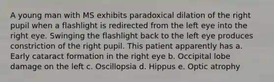 A young man with MS exhibits paradoxical dilation of the right pupil when a flashlight is redirected from the left eye into the right eye. Swinging the flashlight back to the left eye produces constriction of the right pupil. This patient apparently has a. Early cataract formation in the right eye b. Occipital lobe damage on the left c. Oscillopsia d. Hippus e. Optic atrophy